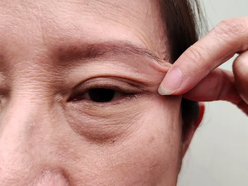 シミ・しわ・たるみ