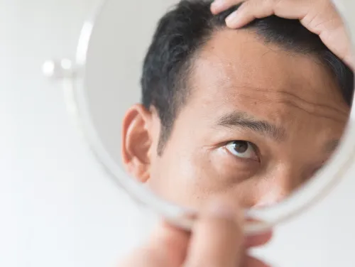 髪の脱毛・薄毛