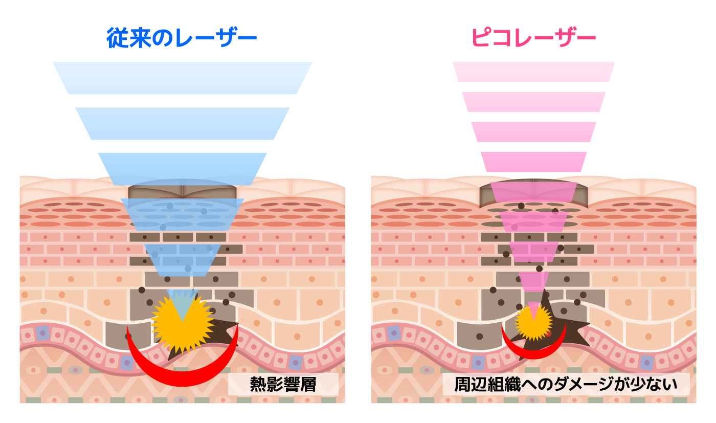 ピコスポットとは